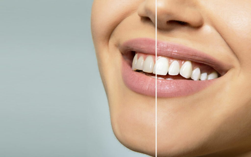 Decoding the Role of Hydration in Teeth Whitening Success