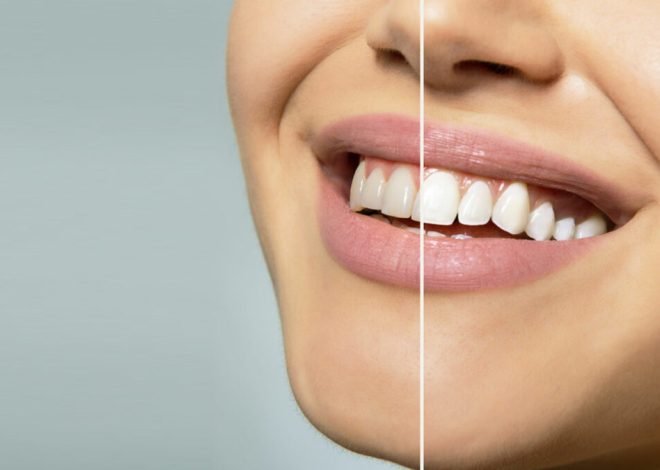 Decoding the Role of Hydration in Teeth Whitening Success