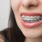 Understanding Retention: How Post-Braces Care Maintains Your Orthodontic Success