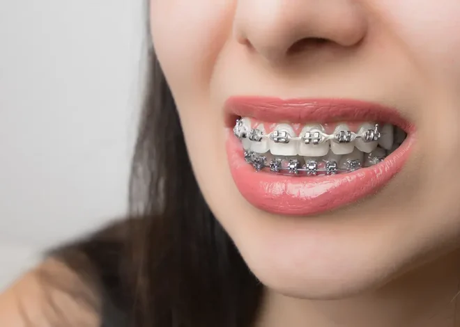 Understanding Retention: How Post-Braces Care Maintains Your Orthodontic Success
