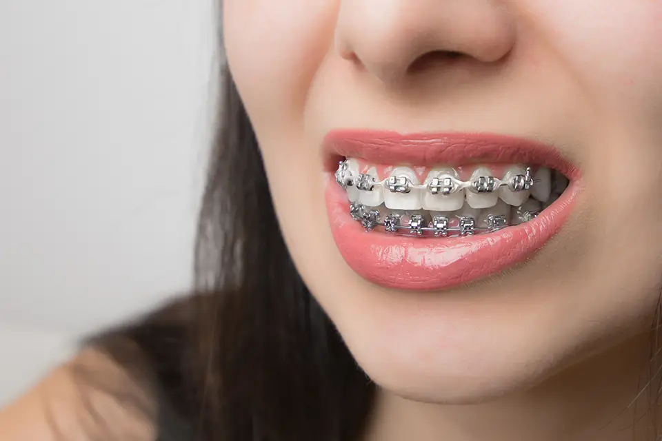 Understanding Retention: How Post-Braces Care Maintains Your Orthodontic Success