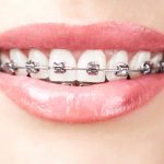 How Braces Influence Sleep Quality and Nighttime Breathing Patterns