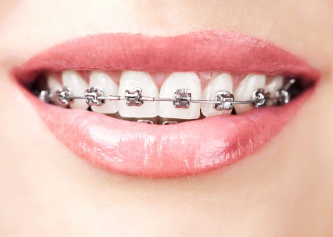 How Braces Influence Sleep Quality and Nighttime Breathing Patterns