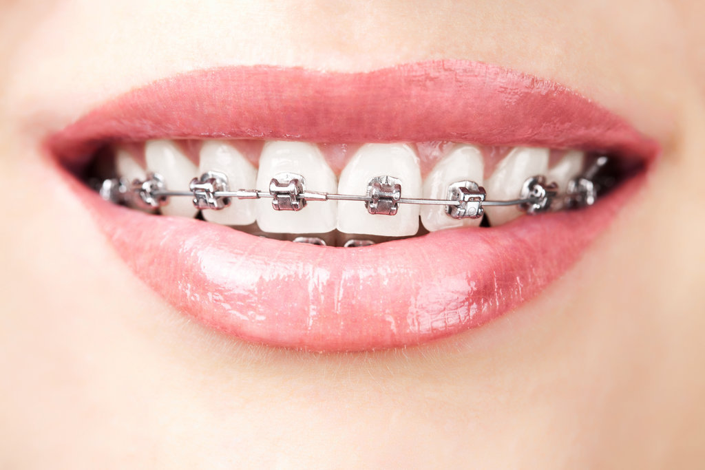 How Braces Influence Sleep Quality and Nighttime Breathing Patterns